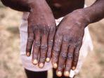 seorang-pasien-monkeypox-di-republik-demokratik-kongo-saat-wabah-pada-tahun-1997.jpg