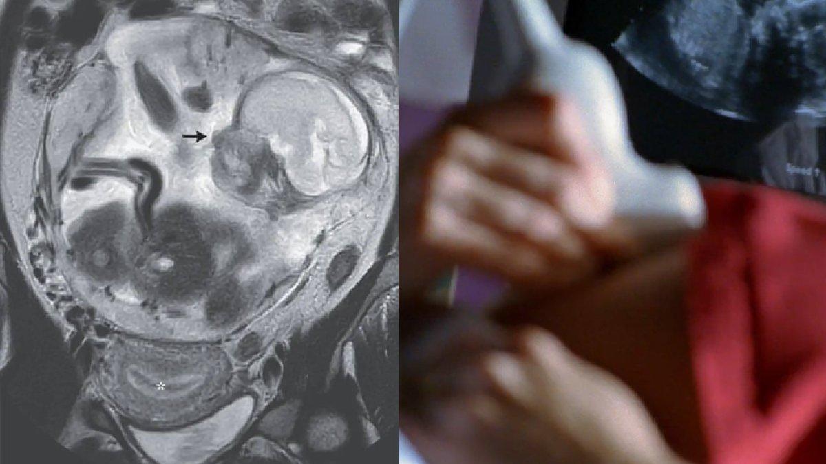 Wanita Syok, Periksa Sakit Perut Malah Dinyatakan Hamil, Tapi Tak Ada Bayi di Rahim, Kasus Langka