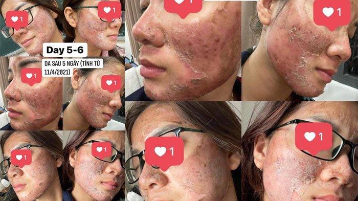 Viral Perawatan Wajah Gadis Ini Justru Berakhir Memilukan, Muka Rusak, Ini Potretnya