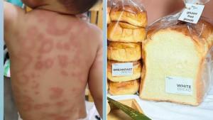 BAKE-N-GRIND-Balita-korban-Bake-n-Grind-yang-mengalami-ruam-merah-hingga-bengkak-di-sekujur-tubuh.jpg