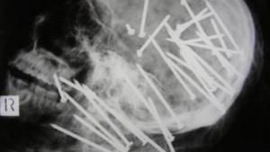 foto-rontgen-yang-memperlihatkan-tengkorak-dengan-banyak-paku-menancap.jpg