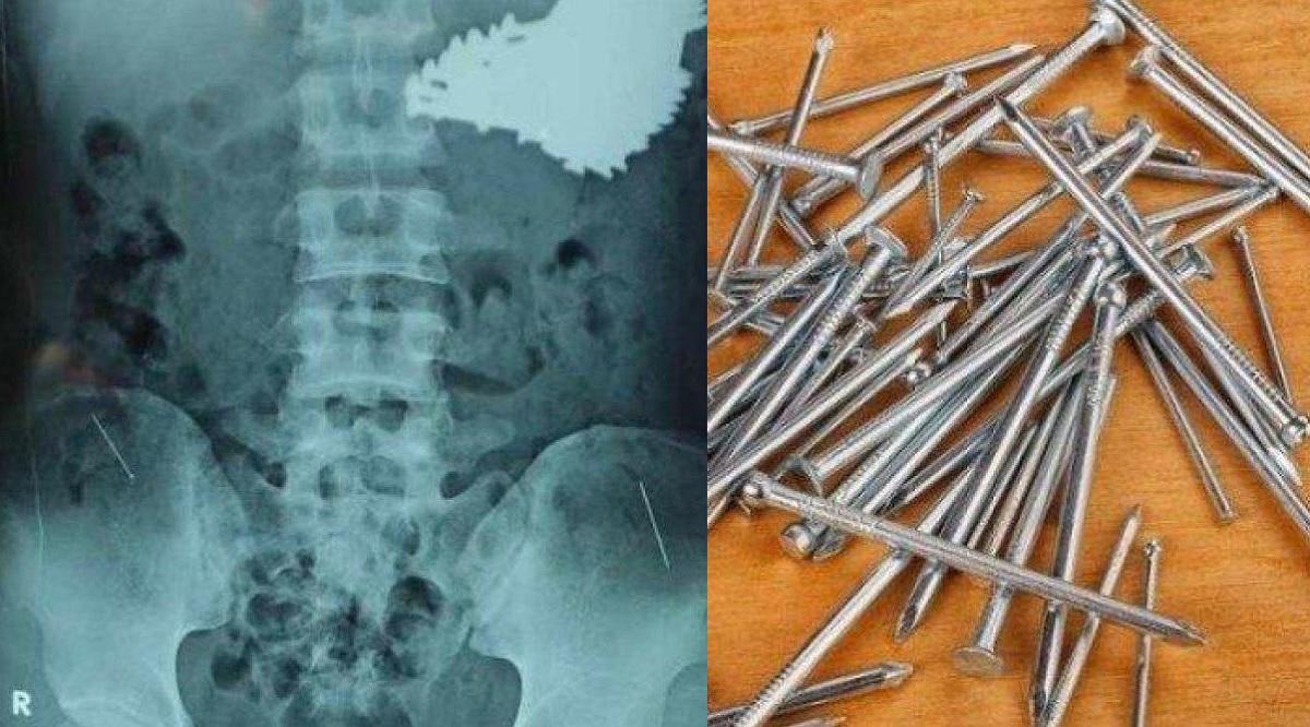 Bagaimana Bisa? Dokter Temukan 70 Paku di Perut Slamet Pemuda Indramayu Jabar, Bukan Karena Santet