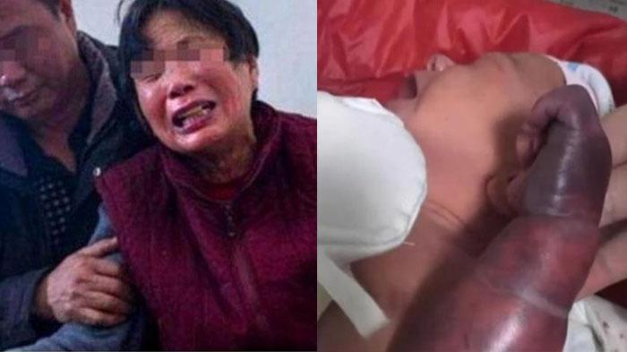 SESAL Nenek Overprotektif, Tangan Cucu Jadi Bengkak, Terpaksa Harus Diamputasi 'Selamatkan Nyawa'