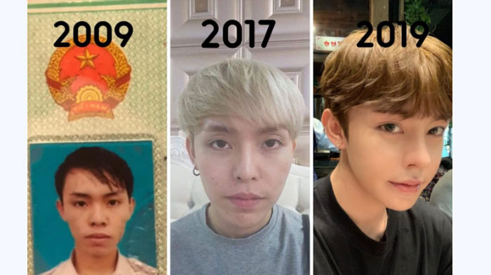 Korban Kecelakaan Tragis 'Diselamatkan' Oplas, Wajah Berubah Bak 'Oppa' Korea, Kini Jadi Model