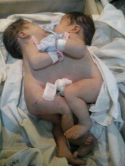 Bayi Kembar Siam Kembali Lahir di Samarinda