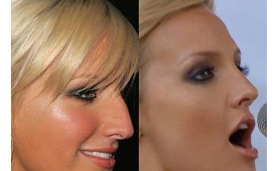 Rhinoplasty, Operasi Percantik Hidung yang Bukan Sekadar Memancungkan