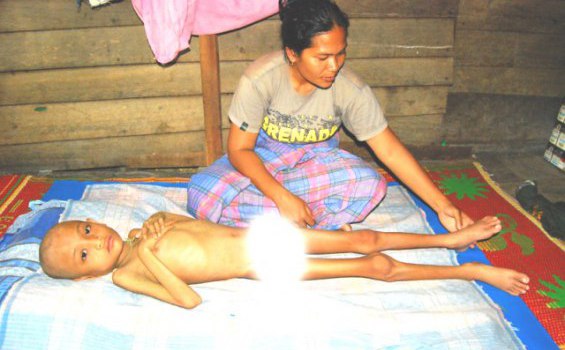 Ratusan Bayi di Aceh Meninggal karena Gizi Buruk