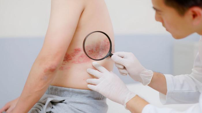 CACAR API - Survei global menunjukkan banyak orang dewasa khawatir terhadap cacar api, dengan 78 persen takut penyakit ini mengganggu aktivitas dan 72 persen khawatir berujung rawat inap, terutama pada penderita penyakit kronis.