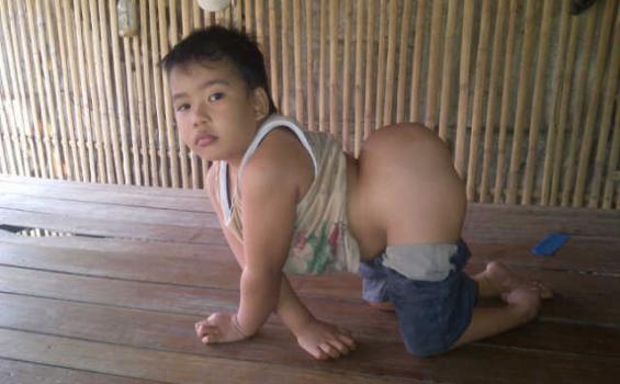 Faris, Bocah Bertumor Ganas di Dubur
