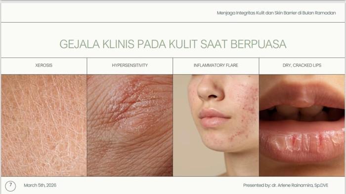 KONDISI KULIT - Dokter Spesialis Dermatologi, Venereologi, dan Estetika, dr Arlene Rainamira, dalam kegiatan edukasi Insights on Healthy Skin, Nutrition, and Self-Care, di Jakarta, baru-baru ini, menjelaskan, gejala dan perawatan kulit minimalis saat bulan puasa.
