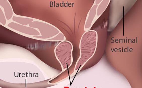 Terapi Baru Kanker Prostat Tak Sebabkan Impotensi