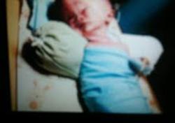 Bayi Enam Hari Terbaring Lemah di RSUD Akibat Hydrocephalus