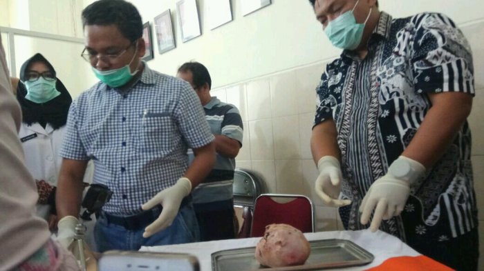 Ini penjelasan Medis Mumi Janin Berusia 37 Tahun dalam Rahim Tunyatun