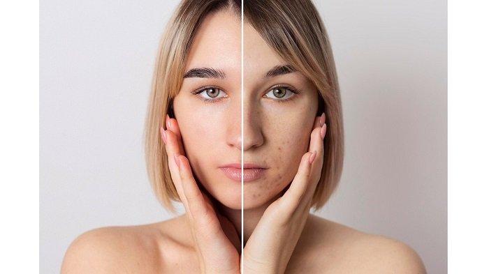 Ciri-ciri Kulit dan Wajah yang Terkena Merkuri - TribunNews.com