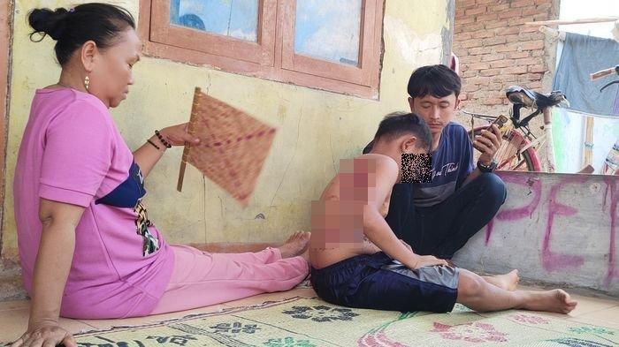 Bocah Berusia 10 Tahun Disiram Air Panas oleh Buyutnya, Mulai Ketiak hingga Pinggang Melepuh