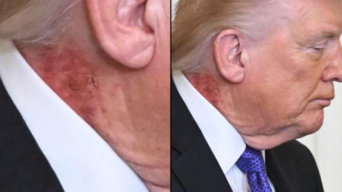 Bercak merah di leher Presiden Amerika Serikat (AS) Donald Trump menarik perhatian para fotografer.
