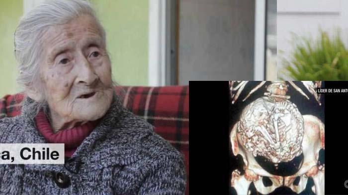 Janin di Perut Nenek 91 Tahun Ini Semula Dikira Tumor