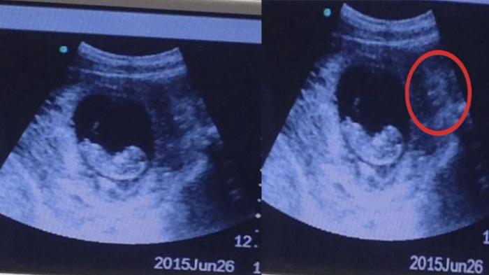 Heboh Citra Misterius di Foto USG Bayi: Benarkah Itu Sosok Iblis?