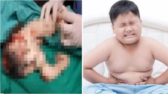 Remaja Ini Mengeluh Sakit di Perut, Ternyata Ada Saudara Kembarnya yang Tak Dilahirkan di Dalamnya!
