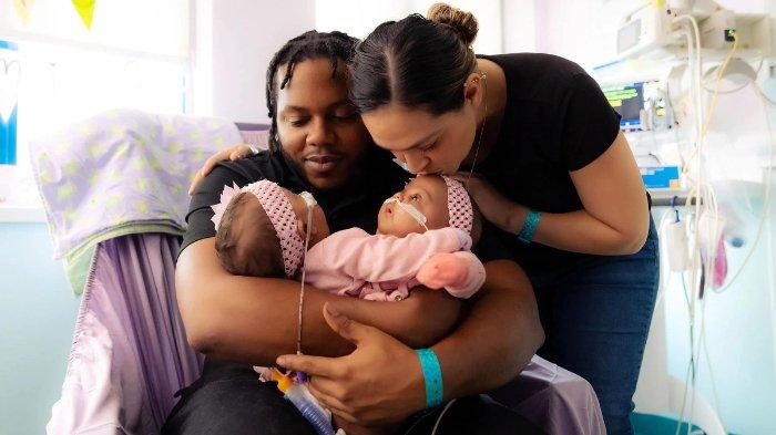 Dokter di Texas Berhasil Pisahkan Bayi Kembar Siam setelah Operasi selama 11 Jam