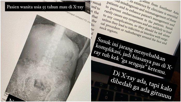 VIRAL Foto X-Ray Ratusan Jarum Diduga 'Susuk' Bersarang dalam Pasien Wanita 55 Tahun, Ini Faktanya