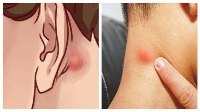 Benjolan di Leher Sering Diabaikan, Tak Terasa Sakit Tapi Lambat Laun Ganggu Kualitas Hidup