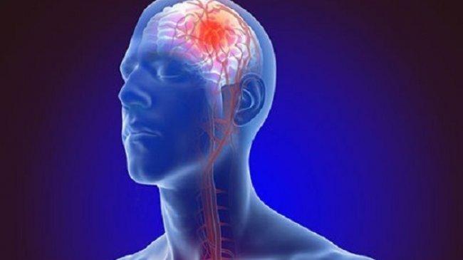 Jangan Abaikan Gejala Kebas dan Bicara Pelo, Bisa Jadi Stroke Ringan