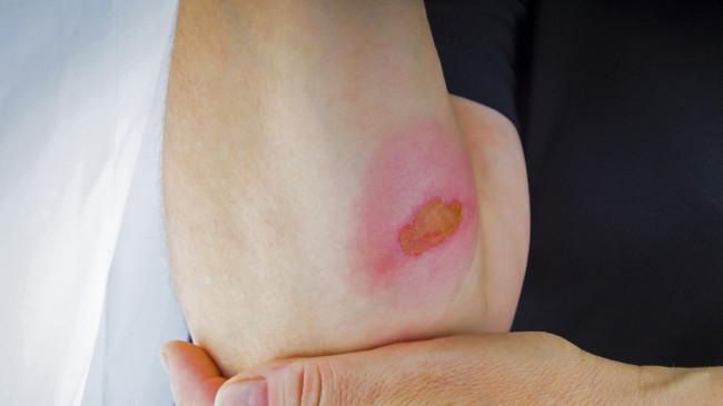 Mitos Keropeng Bikin Luka Cepat Sembuh, Ini Penjelasan Dokter yang Sebenarnya