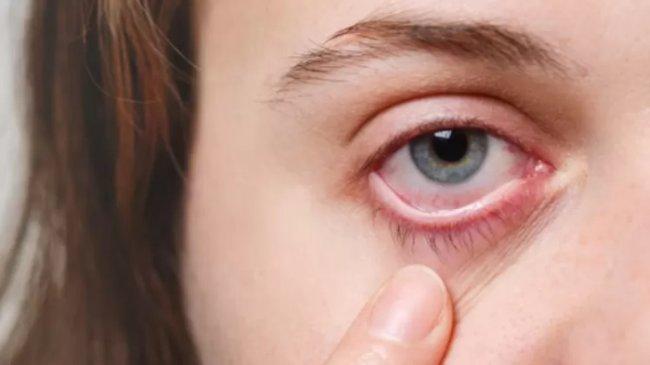 Dry Eye Bisa Merusak Kornea, Gangguan Mata yang Sering Diabaikan tapi Berbahaya