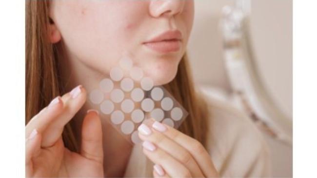 Kisah Pimple Patch, dari Kebiasaan Bangsawan hingga Jadi Sahabat Perempuan Modern
