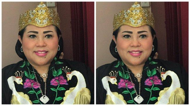 Cerita Nunung dan Pentingnya Deteksi Dini Kanker Payudara di Stadium 0