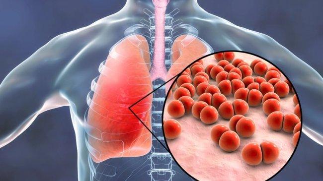 Flu Berkepanjangan Bisa Picu Pneumonia, Dokter Paru Ingatkan Jangan Anggap Remeh