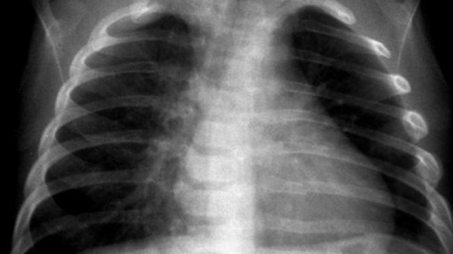 Kenali Gejala Pneumonia Lebih Awal, Ini Panduan Lengkap Agar Anak Tidak Terlambat Ditangani