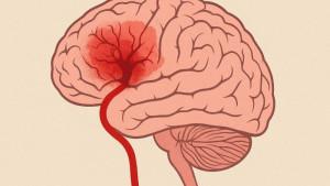 ILUSTRASI-STROKE-Gambar-ini-dibuat-menggunakan-AI.jpg