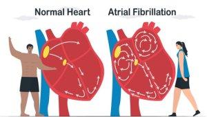 atrial-fibrilasi_1.jpg