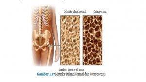 matriks-tulang-normal-dan-osteoporosis.jpg