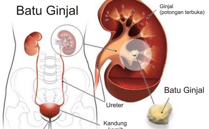 20140907_071120_batu-ginjal.jpg