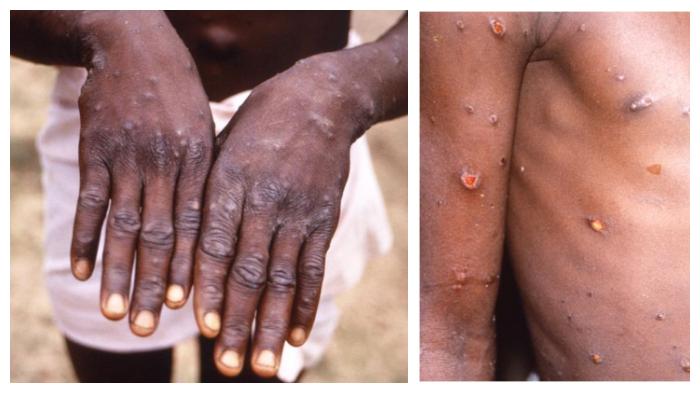 6-fakta-virus-monkeypox-penyakit-cacar-monyet-yang-pertama-kali-muncul-di-singapura.jpg