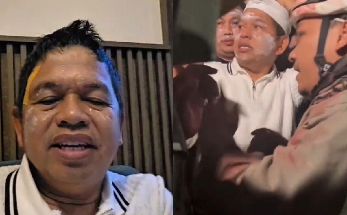 Dedi Mulyadi Pakai Koyo di Jidat Usai Engap Kena Gas Air Mata, Begini Kondisinya