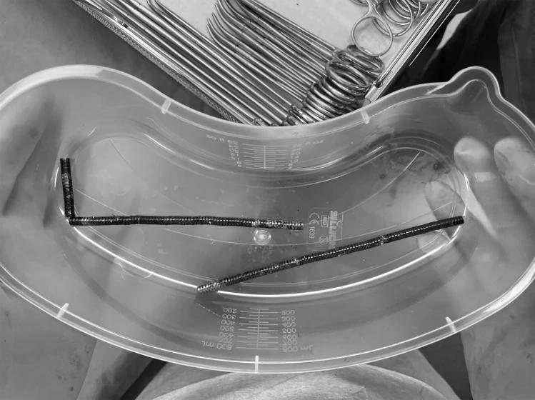 Remaja Selandia Baru Telan 100 Magnet, Dokter Terpaksa Angkat Bagian Usus yang Rusak