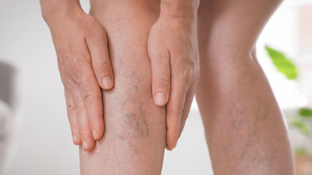 Spider-veins-1-22042026.jpg