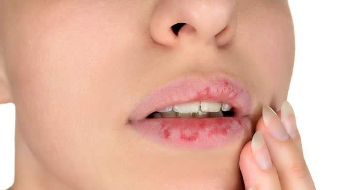 alami-bibir-pecah-pecah-saat-traveling-oleskan-5-bahan-alami-ini-untuk-mengatasinya.jpg