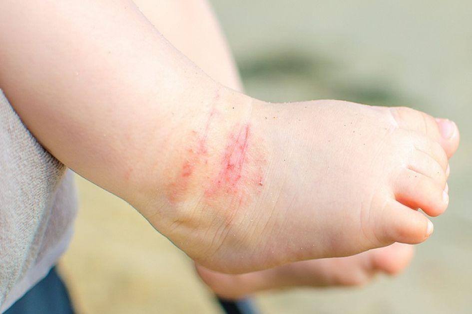 Kulit Bayi Tampak Kering dan Berkerak? Waspada Terkena Eksim