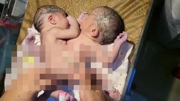 bayi-jenis-kelamin-siam12323.jpg