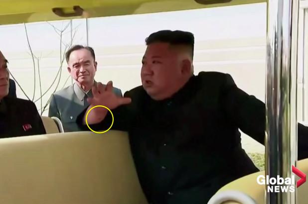 bekas-luka-di-tangan-kim-jong-un.jpg