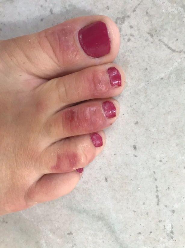 Covid fingers and toes 