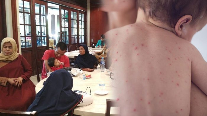 Komplikasi Fatal saat Anak Terkena Campak, Tak Boleh Disepelekan