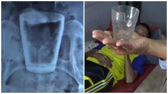 FAKTA Gelas Kaca Ditemukan Dalam Perut Pria di Jember: Sakit Selama 3 Bulan, Dokter Beri Penjelasan