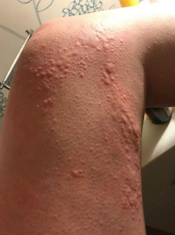 Hive-type rash 