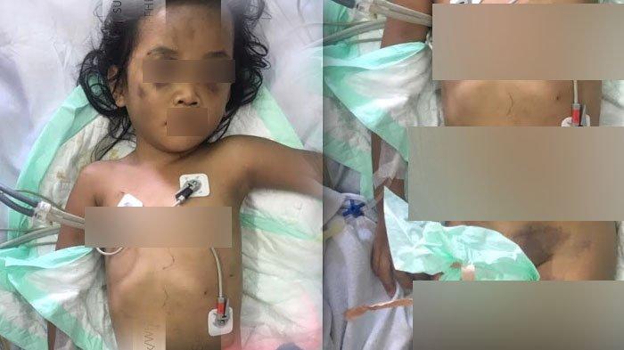 igauan-bocah-4-tahun-tubuh-penuh-luka-lebam-di.jpg